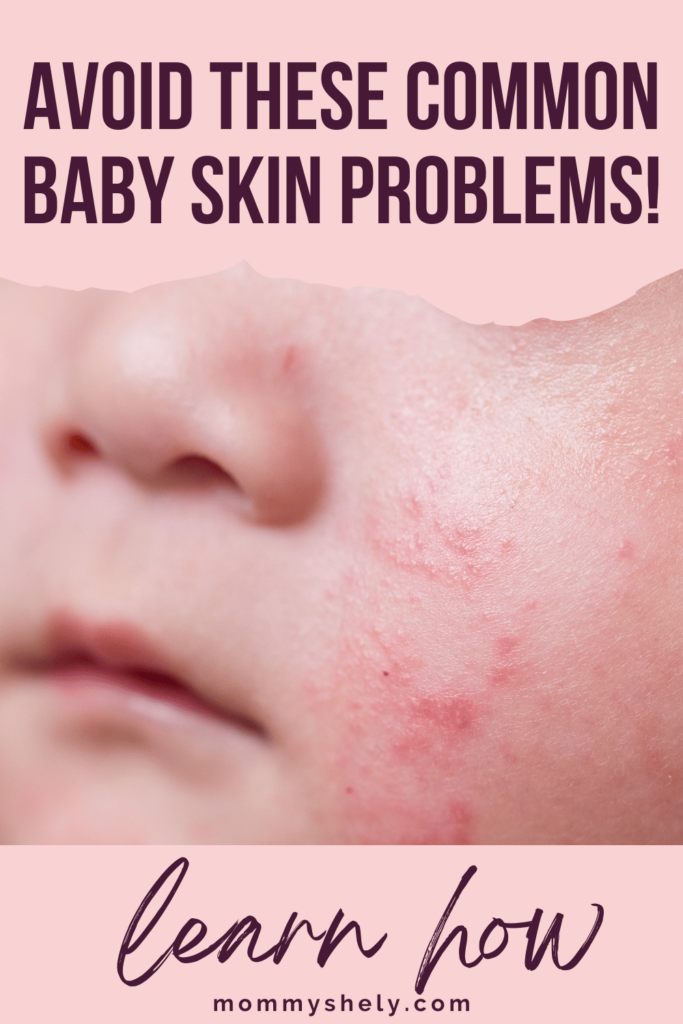 Avoid These Common Baby Skin Problems!