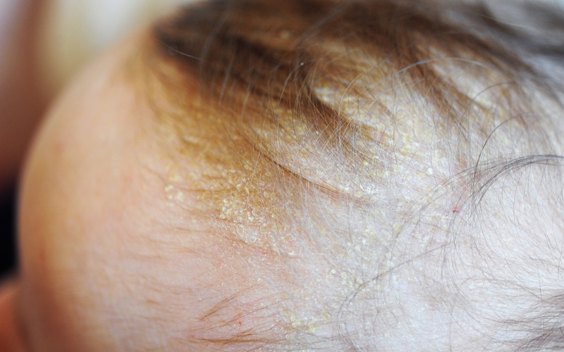 Close up photo on baby's head with cradle cap