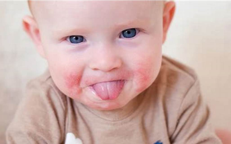 baby suffering from a rash around his mouth