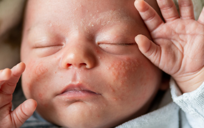 Close up photo on baby's face suffering from baby acne