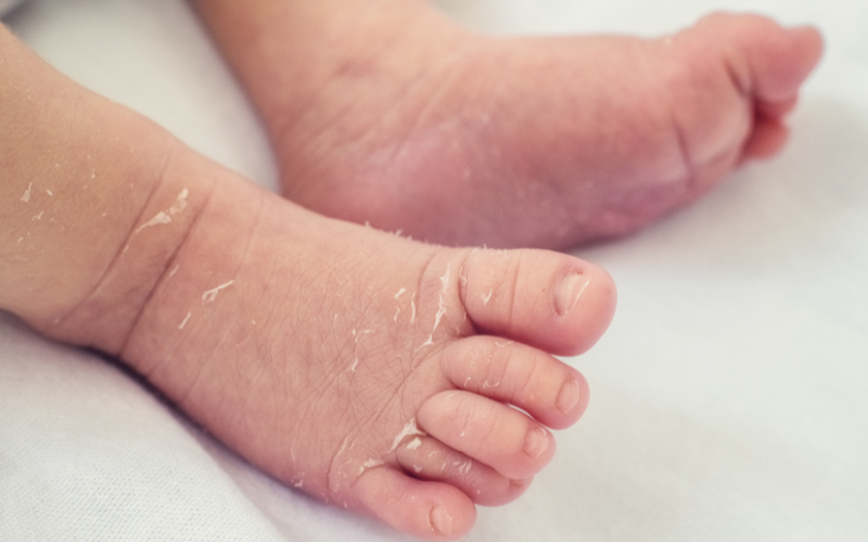 close up on baby's legs showing his dry skin