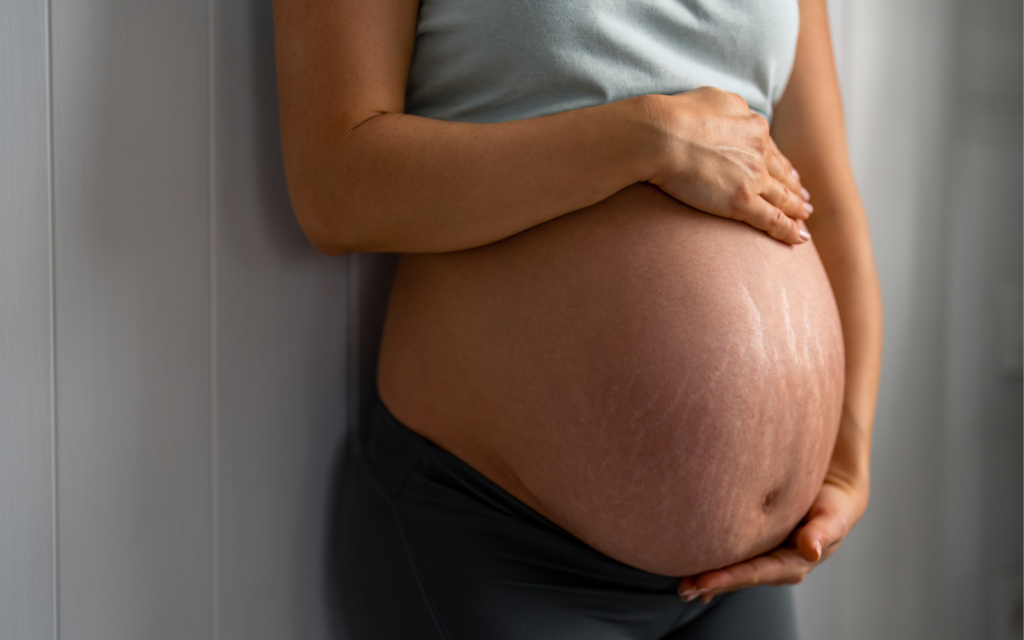 Pregnant woman with stretch marks